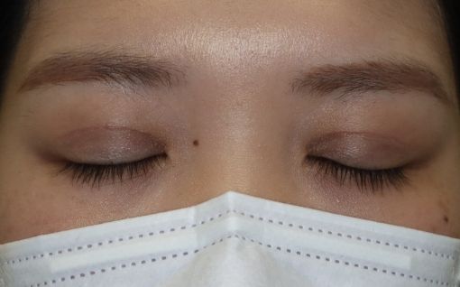 術後1ヶ月 閉瞼