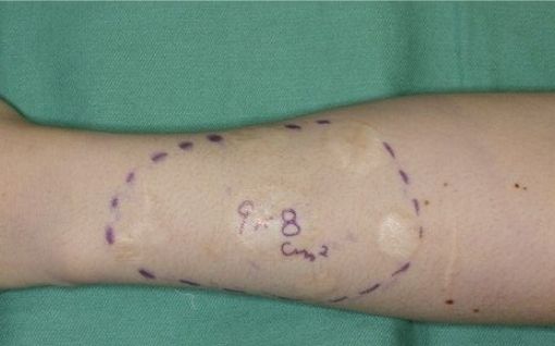 術前のデザイン