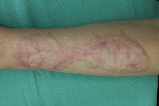 術後12ヶ月経過