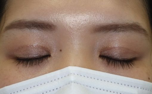 術後3ヶ月 閉瞼