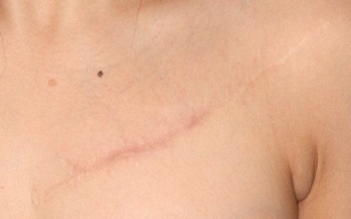 刺青・タトゥ切除の傷跡の修正 術後