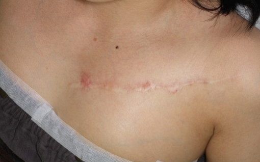 傷跡修正の診察