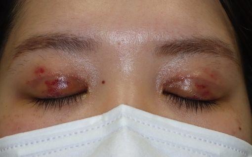 術後1週間 閉瞼