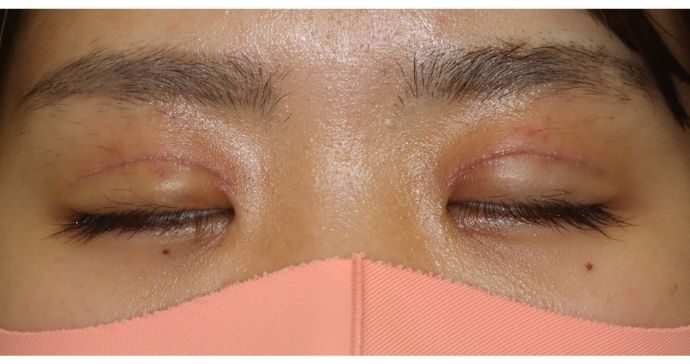 術後1週間 閉瞼