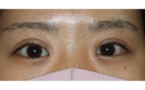 二重整形切開法術後_他院埋没法から切開法の二重整形