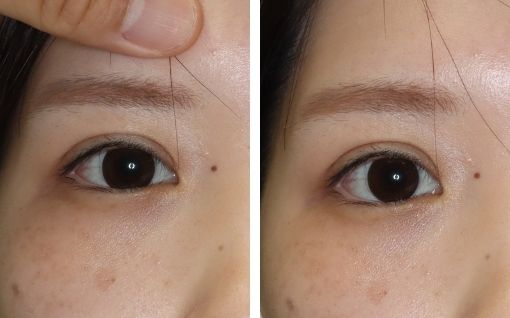 術後6ヶ月 右眉が挙上しない様に抑制