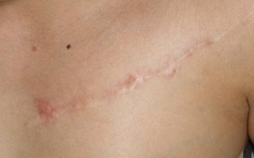 刺青・タトゥ切除の傷跡の修正　術前