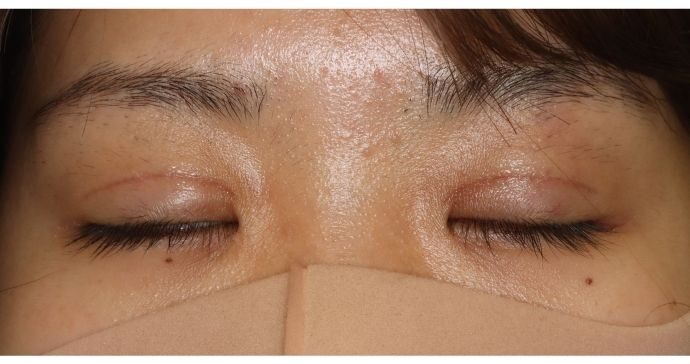 術後1ヶ月 閉瞼