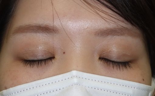 術後6ヶ月 閉瞼