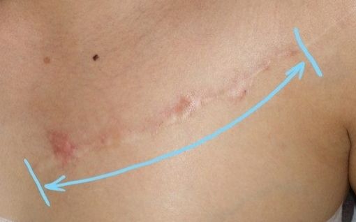 傷跡の修正範囲