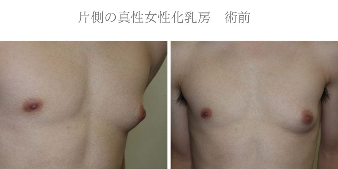 片側の真性女性化乳房術前症例写真