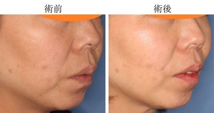 術前と術後の比較