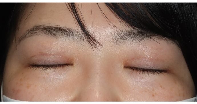 術後3ヶ月 閉瞼