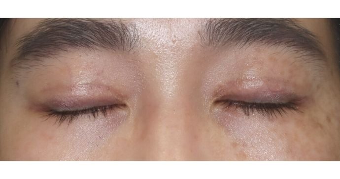 術後2ヶ月 閉瞼