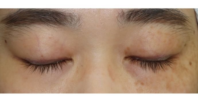 術前の診察 閉瞼