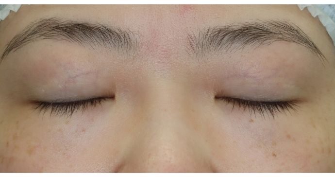 術前の診察 閉瞼