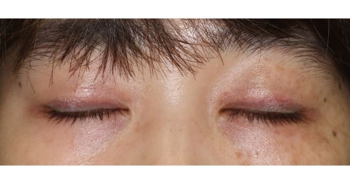 術後3ヶ月 閉瞼