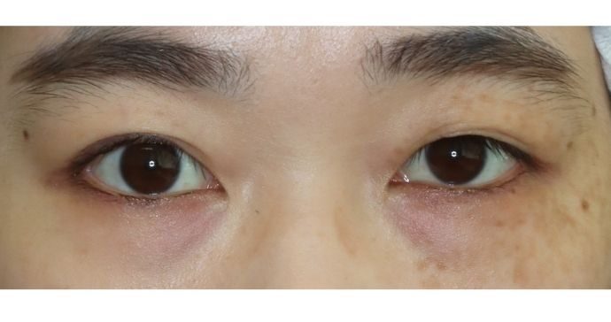 術前の診察 開瞼