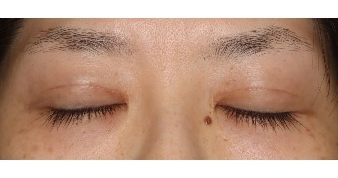 手術1ヶ月後 閉瞼