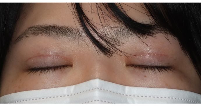 術後2ヶ月 閉瞼