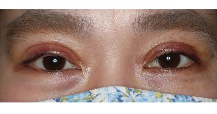 術後1週間 開瞼