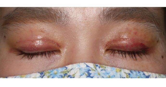 術後1週間 閉瞼