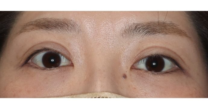 術後3か月 閉瞼