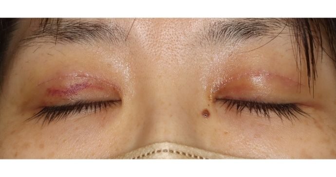 術後1週間 閉瞼