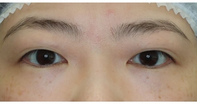 術前の診察 開瞼