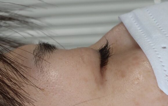 術後真横から撮影