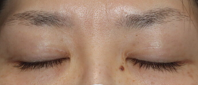 術後6ヶ月 閉瞼