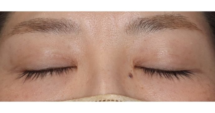 術後3ヶ月 閉瞼