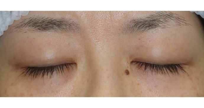 術前の診察(閉瞼)