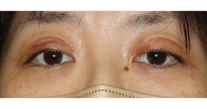 術後1週間 開瞼