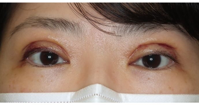 術後1週間 開瞼