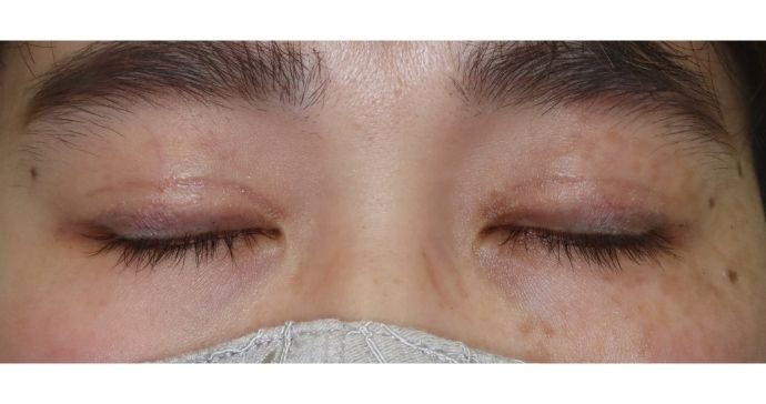 術後1ヶ月 閉瞼