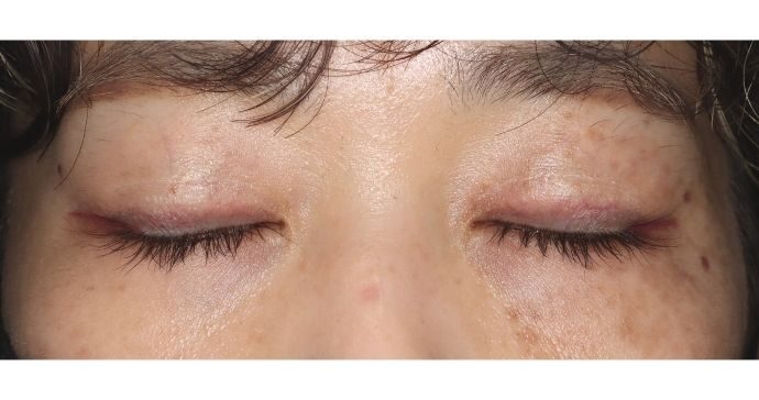 術後11ヶ月閉瞼