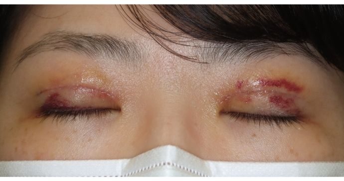 術後1週間 閉瞼