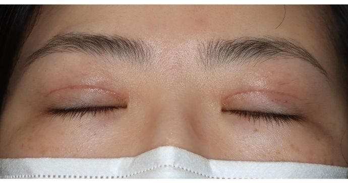 術後1ヶ月 閉瞼