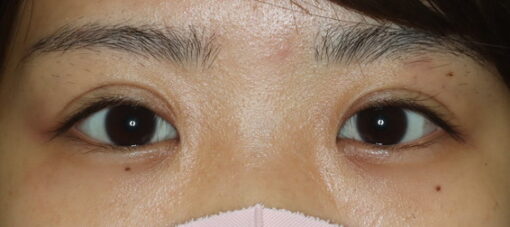 術後6ヶ月開瞼