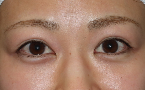 埋没法からの二重整形切開法術前518×318
