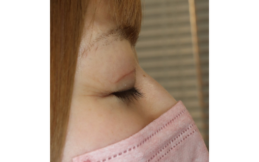 術後1ヶ月 右側面