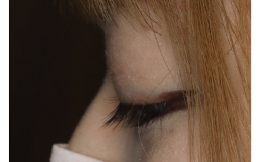 術後6か月 閉瞼 左側面