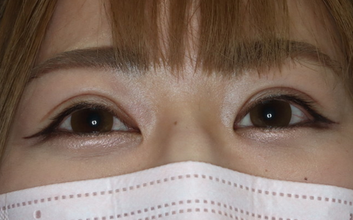 術後3ヶ月 開瞼