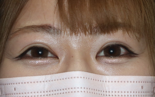 埋没法からの二重整形切開法術後6か月開瞼518×318
