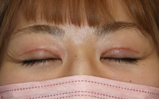 術後1ヶ月 閉瞼