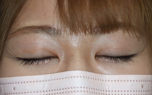 術後6ヶ月 閉瞼