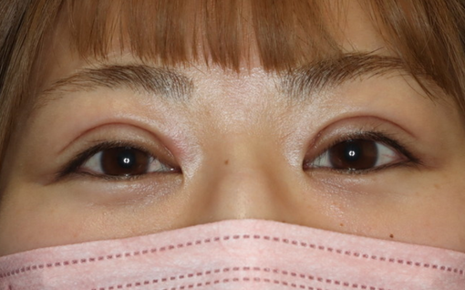 術後1ヶ月 開瞼