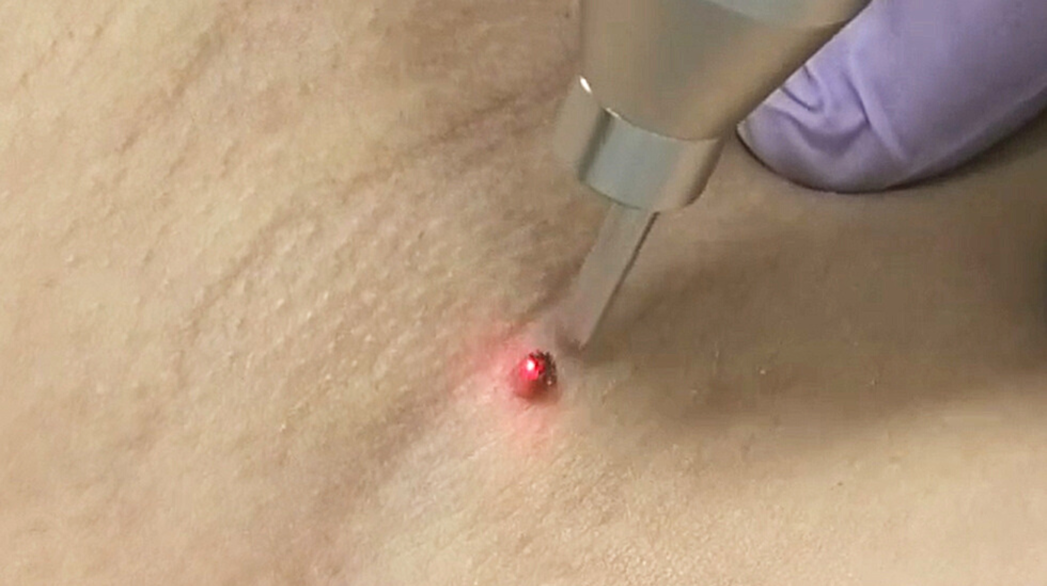 ノーマルハンドピース照射風景(疣贅)