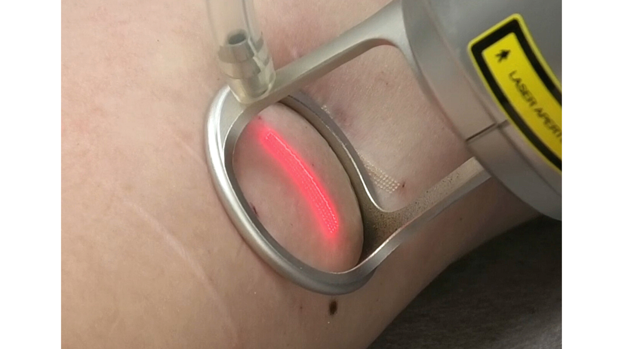 スキャナーハンドピース照射風景(瘢痕)